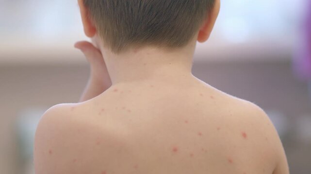 The child is experiencing a skin condition chickenpox affecting their back, which raises concern