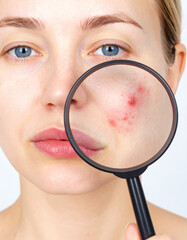 A close-up of a woman's face examining acne under a magnifying glass, highlighting skin texture and imperfections