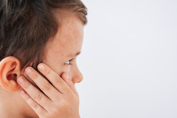 The Coxsackie virus. Symptoms on children's facial skin. Painful rash, red spots, blisters.