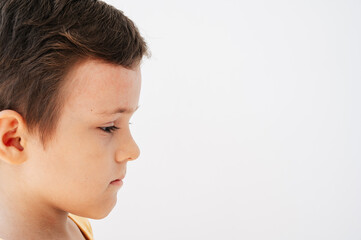 The face of a child infected with the Coxsackie virus. Spots, Blisters and a rash on the boy's face.