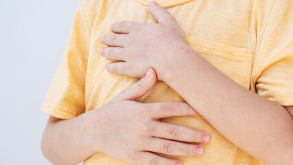 Rash and red blisters on the skin of a child's hands caused by the Coxsackie virus.