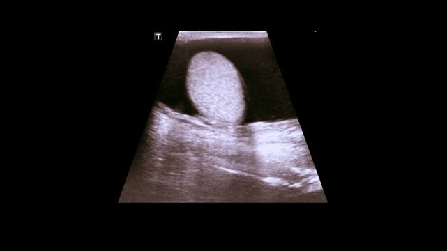 Hydrocele is an abnormal collection of serous fluid between the two layers of tunica vaginalis of testis
Ultrasound is the first modality usually used to evaluate hydrocele