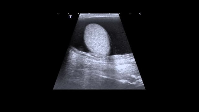  Hydrocele is an abnormal collection of serous fluid between the two layers of tunica vaginalis of testis Ultrasound is the first modality usually used to evaluate hydrocele