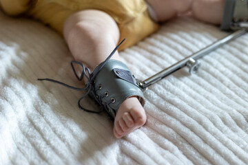 Infant Foot with Brace on Bed for Corrective Support