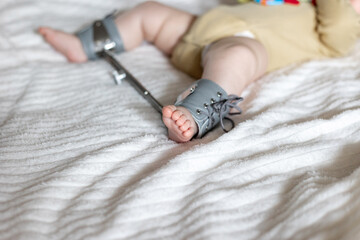 Infant's foot secured in a Wilensky splint, designed for treating hip dysplasia. The splint aids in...