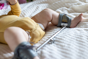 Infant's foot secured in a Wilensky splint, designed for treating hip dysplasia. The splint aids in...
