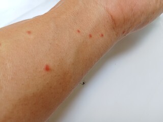 Fototapeta premium Mosquito bite in hand isolated on a white background 