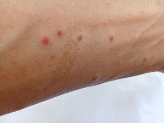 Mosquito bite in hand isolated on a white background 