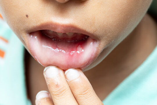Child showing aphthous stomatitis or canker sores inside mouth, touching lip with fingers