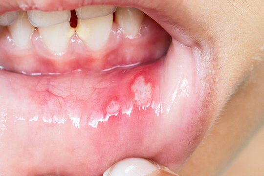 Aphthous stomatitis affecting inner lip of young child: symptoms and treatment
