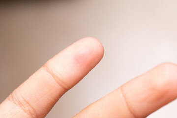 Close-up of blood blister on index finger showing injury