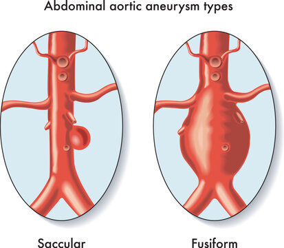 Medical illustration of Abdominal aortic aneurysm types, with annotations