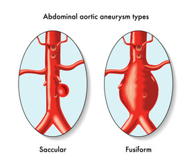 Medical illustration of Abdominal aortic aneurysm types, with annotations