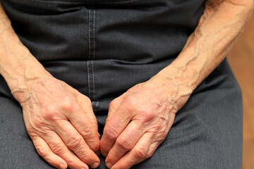 Hands of an old woman pensioner with varicose veins, arthritis, arthrosis. Sick varicose hands of an elderly person after 80 years.