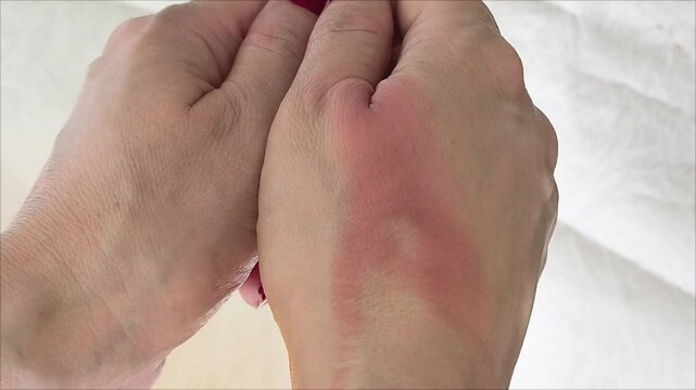 A red burn on his arm. First degree skin burn. Dermatology, traumatology. Skin inflammation.