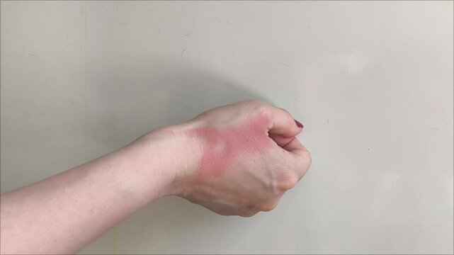 First degree burn on the arm. The woman was burned by boiling water. Skin damage. Inflamed red skin on the arm.