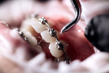 Metal braces on a young woman's teeth. Close-up of beriket rinsing with instruments in a dental...