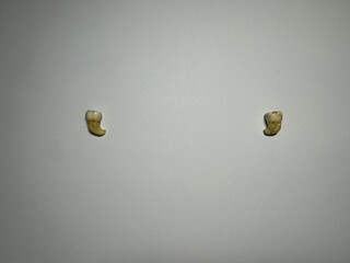 Wisdom teeth removed, with a crooked root. Eights