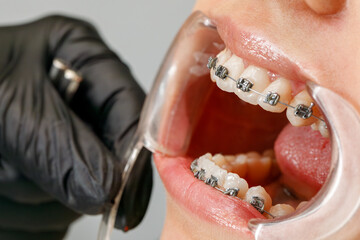 Side view of orthodontic treatment with braces and tools