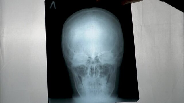 X-ray of the skull.
The video shows a frontal X-ray of a human skull placed on the lumen. 
The bones of the skull, eye sockets and nasal cavity are visible.