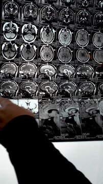 The doctor points to the MRI scan of the brain.
close-up of a series of MRI scans of the human brain in various projections. for the analysis of pathological changes or for educational purposes.
