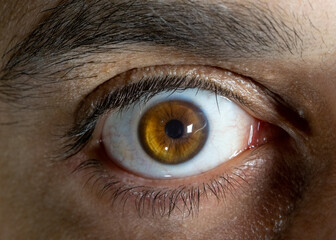 Macro close-up of a human right eye with advanced keratoconus. Visible corneal thinning, conical...