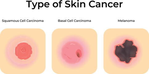 Types of Skin Cancer Squamous Basal Cell and Melanoma