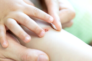 아기가 모기에 물린 부위를 긁어 상처난 곳에 연고를 바르는 손