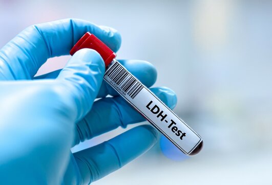 Blood sample tube for lactate dehydrogenase (LDH) test analysis. 