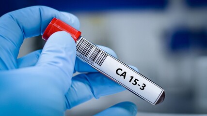 Blood sample tube for CA 15-3 test analysis.