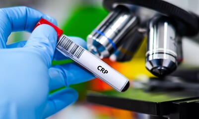 Blood sample tube for C-reactive protein test analysis.