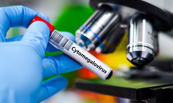 Blood sample tube for cytomegalovirus (CMV) test analysis.
