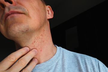 Fototapeta premium Skin irritation after shaving. Skin irritation on male neck after shaving. Close-up photo.