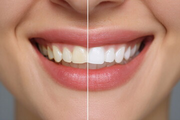 Dental teeth whitening before and after concept