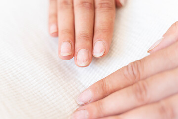 Damaged fingernails from gel polish. Hand care. Nail health. Free space.