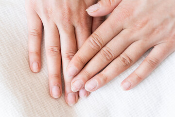 Damaged fingernails from gel polish. Hand care. Nail health. Free space.