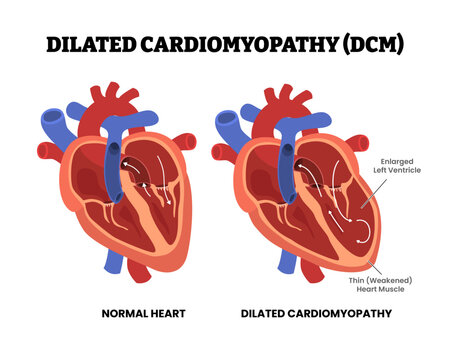 Heart Dilated Cardiomyopathy (DCM), educational medical poster design healthcare scheme, internal organs, cardiovascular disease, heart complication. Labeled enlarged ventricle, thin heart muscle.