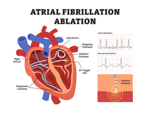 Cardiac ablation for heart atrial fibrillation, educational medical poster design healthcare scheme, internal organs. Labeled ablation catheter ablation, regular irregular heartbeat rhythm ECG.