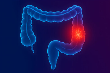 colorectal cancer,  bowel cancer, colon cancer, rectal cancer, tumor, organ, body, human, doctor, hospital, gastroenterologist, proctologist