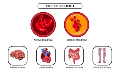 types of ischemia, myocardial and mesenteric ischemia, cerebral stroke and peripheral arterial disease. blood vessel blockage, plaque, infarction and thrombosis. Vector illustration for medic