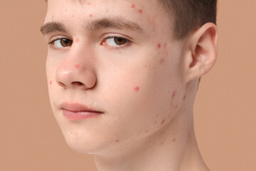 Teenage boy with acne on beige background, closeup