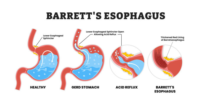 Barrett's Esophagus Stomach Disease or Metaplasia, educational medical poster design healthcare scheme, human stomach internal organs. Labeled thickened red lining esophagus. GERD, acid reflux.