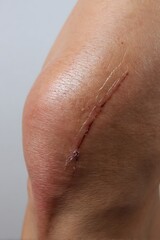 Fototapeta premium a close-up of a post-surgery scar on the upper leg, smooth healing tissue, realistic skin detail, medical lighting,