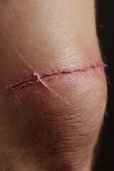 Naklejka premium a close-up of a post-surgery scar on the upper leg, smooth healing tissue, realistic skin detail, medical lighting,
