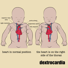 Dextrocardia is a congenital condition in which the heart is inverted from its natural position.