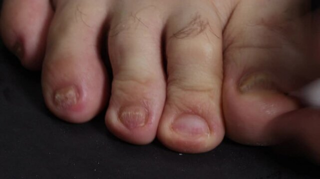 Wiping toes with cotton wool soaked in disinfectant solution on a dark background.