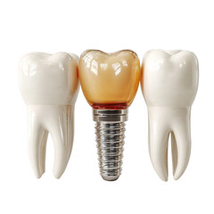 Dental implant restoration demonstrates the artificial tooth fixed in place between healthy teeth in a concept of modern dentistry and restoration in a white scene.