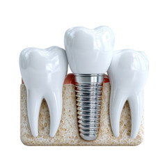 Dental implant is showcased amongst healthy teeth in a cross section of the jawbone demonstrating modern dentistry and innovative tooth replacement options.