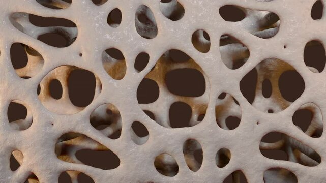 Osteoporosis With Loss of Bone Density