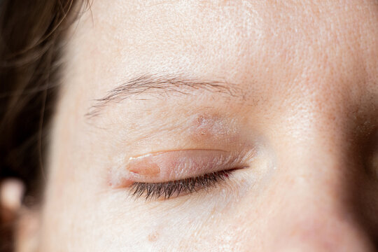 Removed papillomas on the eyelid of a young girl after cauterization, treatment